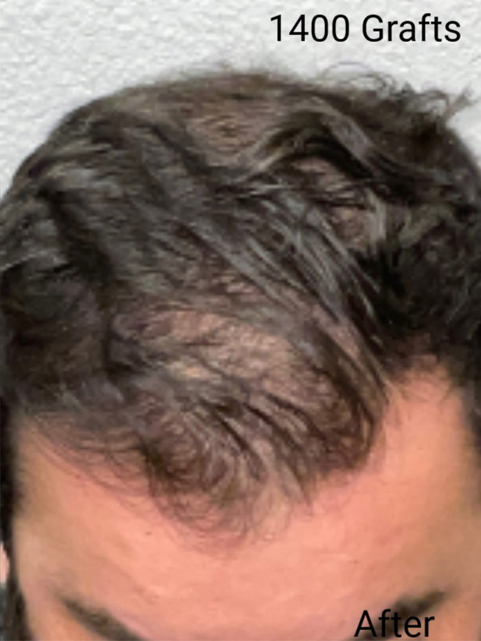 Hair Transplant