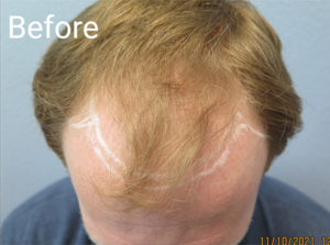 Hair Transplant