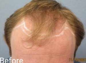 Hair Transplant