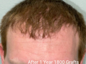 Hair Transplant