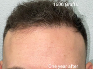 Hair Transplant