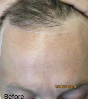 Hair Transplant