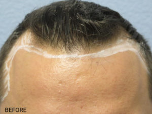 Hair Transplant