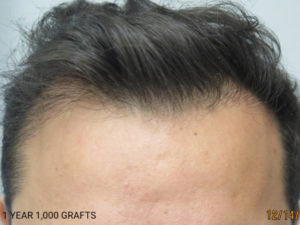 Hair Transplant
