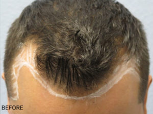 Hair Transplant