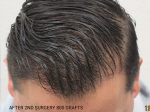 Hair Transplant
