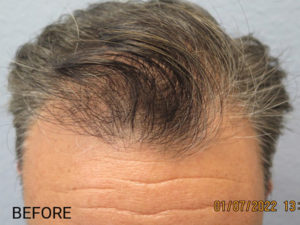 Hair Transplant