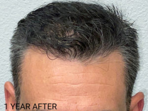 Hair Transplant