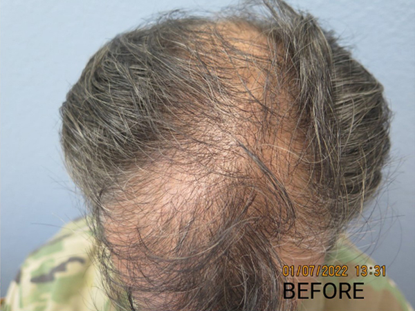 Hair Transplant