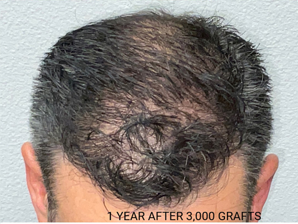 Hair Transplant