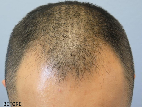 Hair Transplant