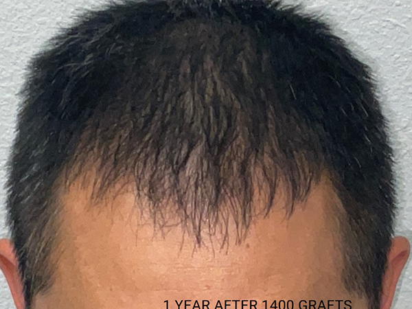 Hair Transplant