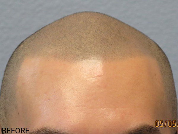 Hair Transplant