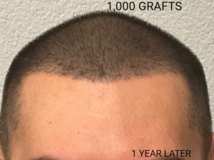 Hair Transplant