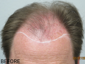 Hair Transplant