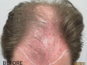 Hair Transplant