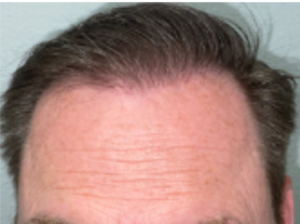 Hair Transplant