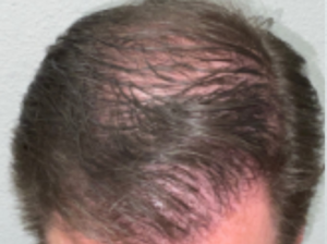 Hair Transplant