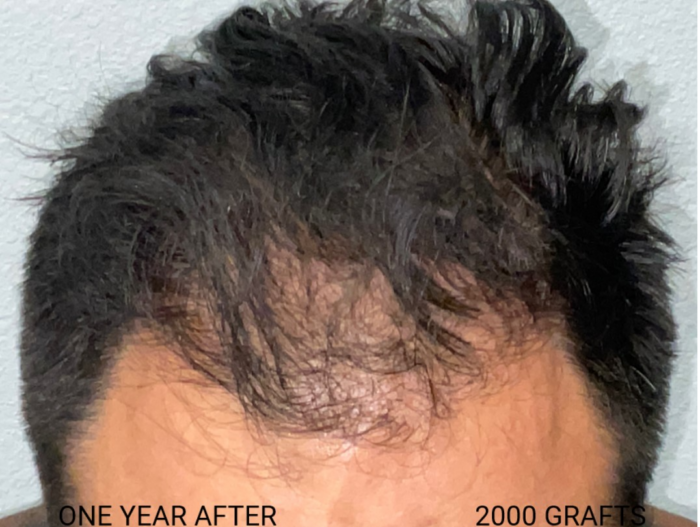 Hair Transplant