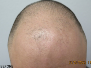 Hair Transplant