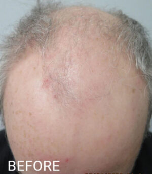 Hair Transplant