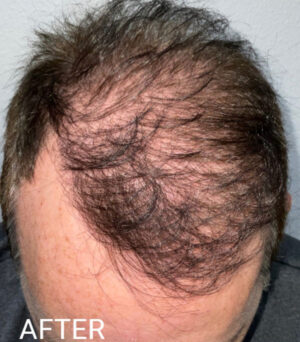 Hair Transplant