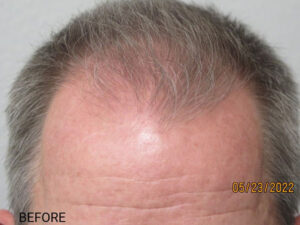 Hair Transplant