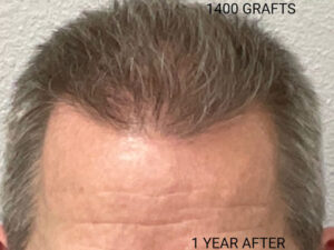 Hair Transplant