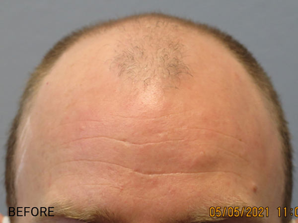 Hair Transplant