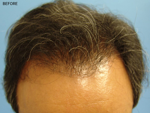 Hair Transplant