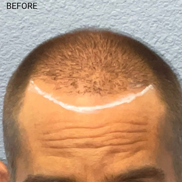 Hair Transplant