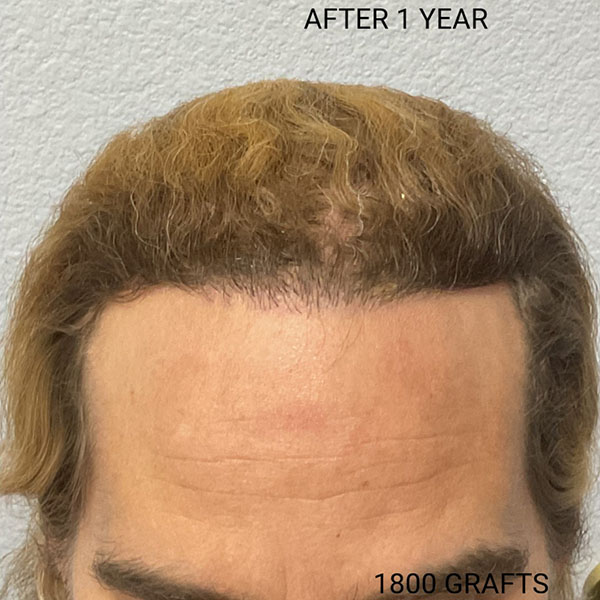 Hair Transplant