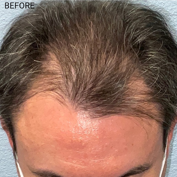 Hair Transplant