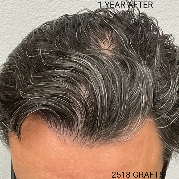 Hair Transplant