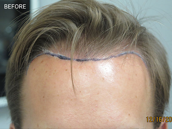 Hair Transplant