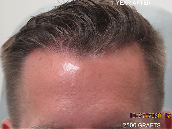 Hair Transplant