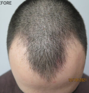 Hair Transplant