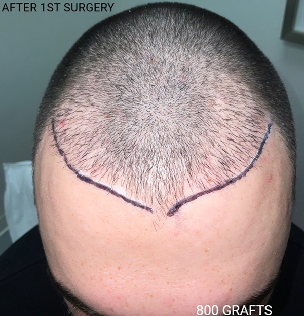 Hair Transplant