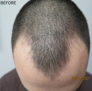 Hair Transplant