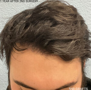 Hair Transplant