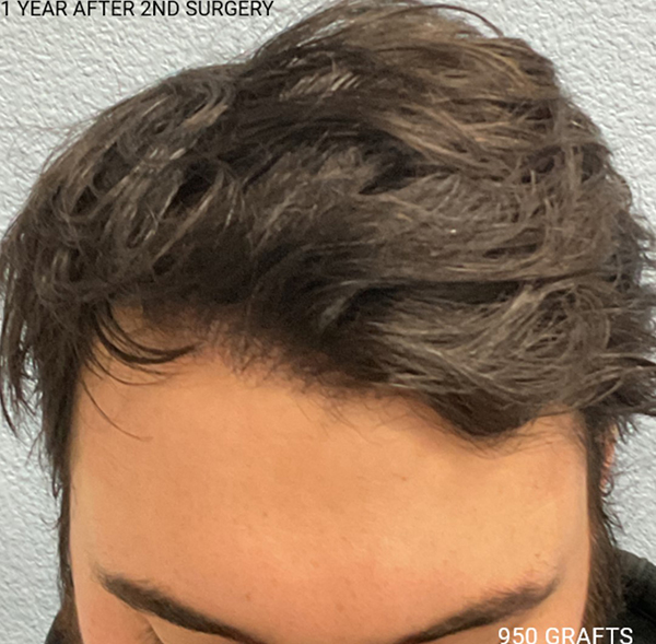 Hair Transplant