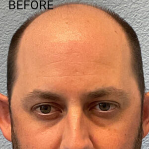 Hair Transplant