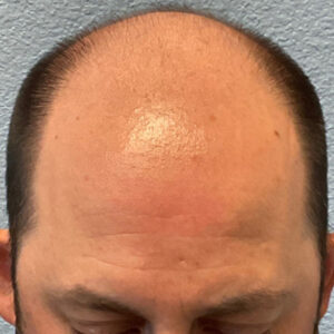 Hair Transplant