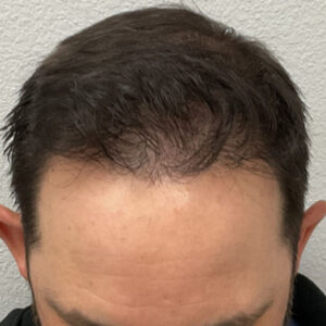 Hair Transplant