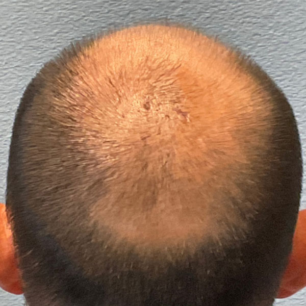 Hair Transplant