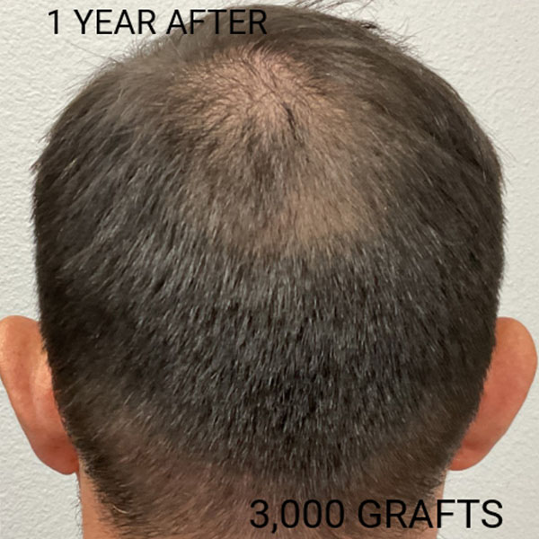 Hair Transplant