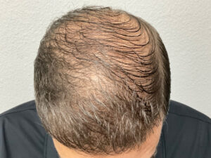 Hair Transplant