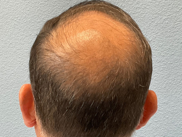 Hair Transplant