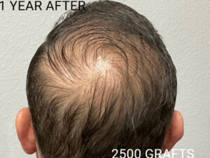 Hair Transplant