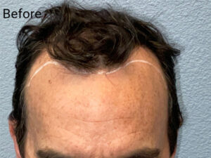 Hair Transplant